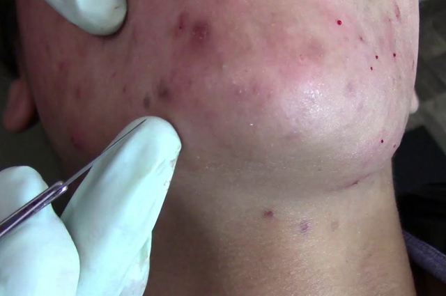 Acne Surgery